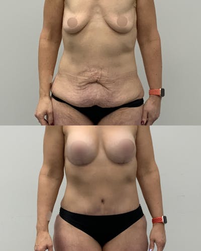 Tummy Tuck Before & After Gallery - Patient 403240 - Image 1