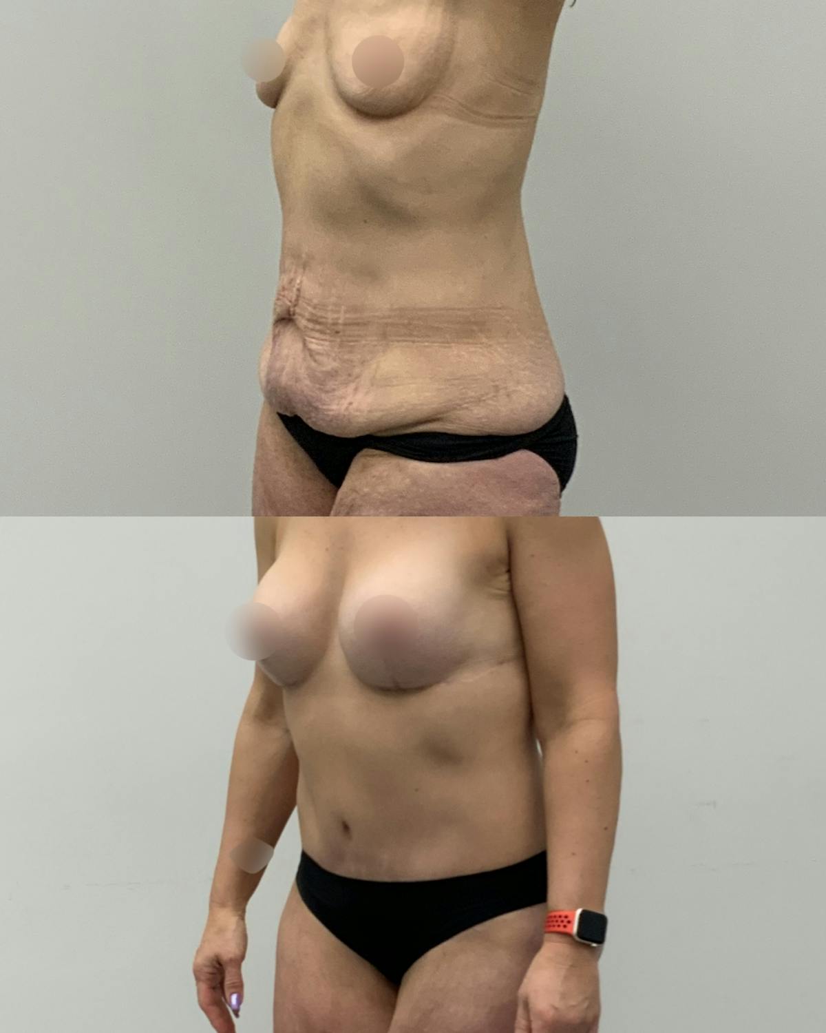 Tummy Tuck Before & After Gallery - Patient 403240 - Image 2