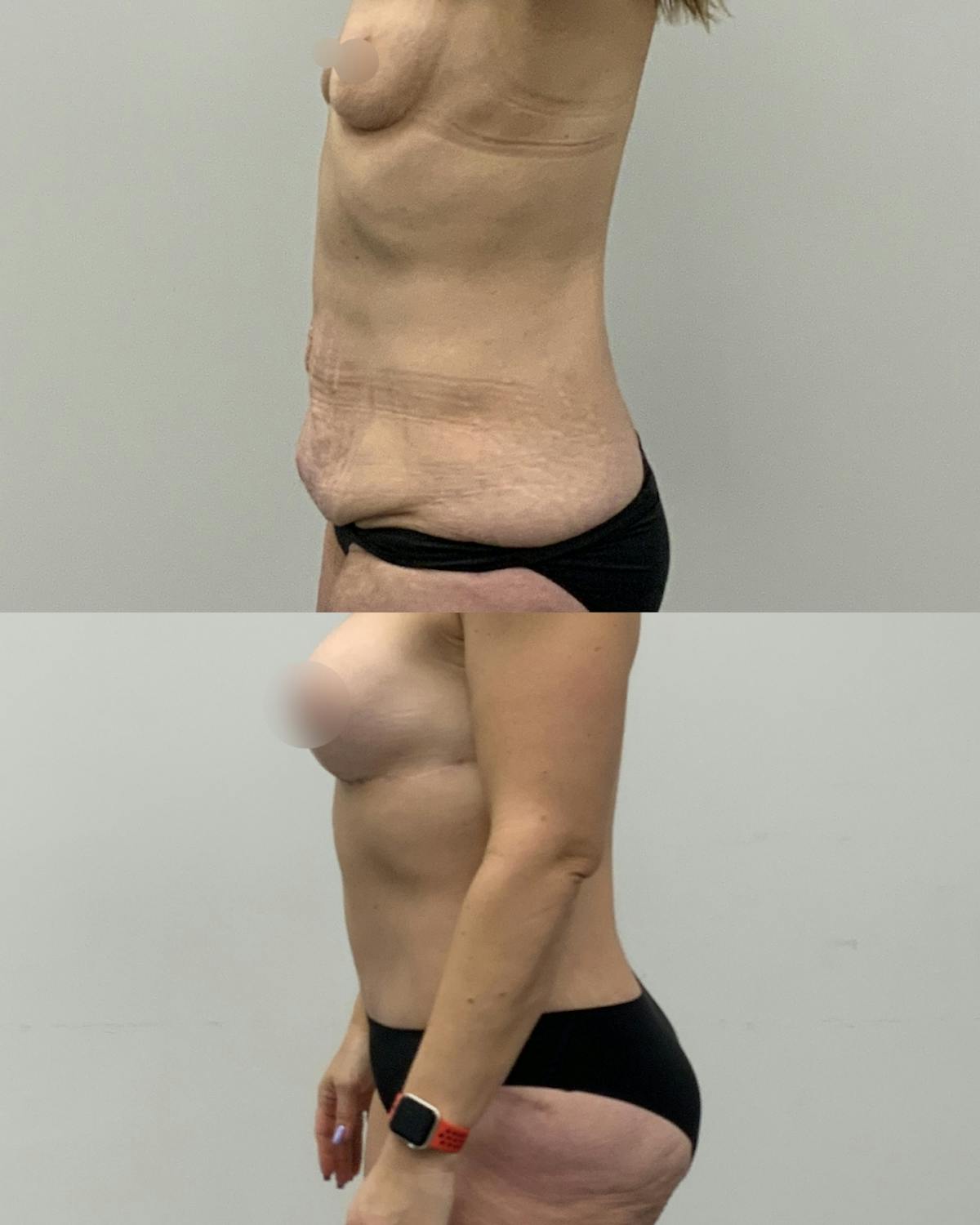 Tummy Tuck Before & After Gallery - Patient 403240 - Image 3