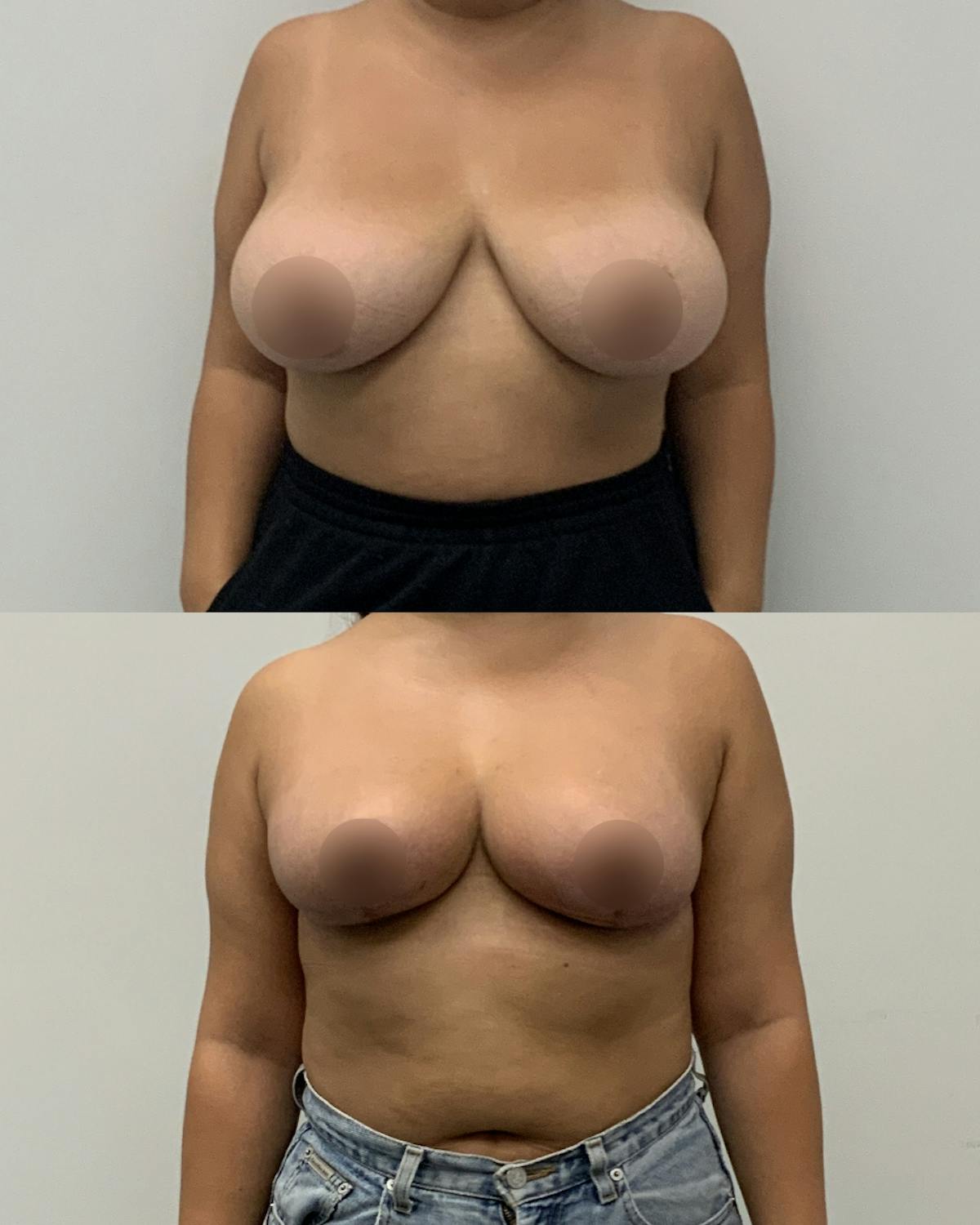Breast Reduction Before & After Gallery - Patient 203182 - Image 1