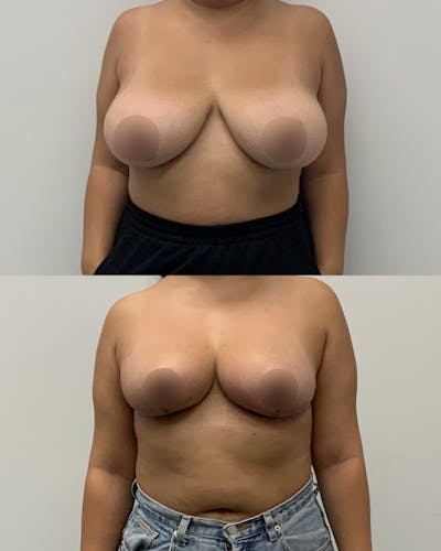 Breast Lift Before & After Gallery - Patient 159248 - Image 1