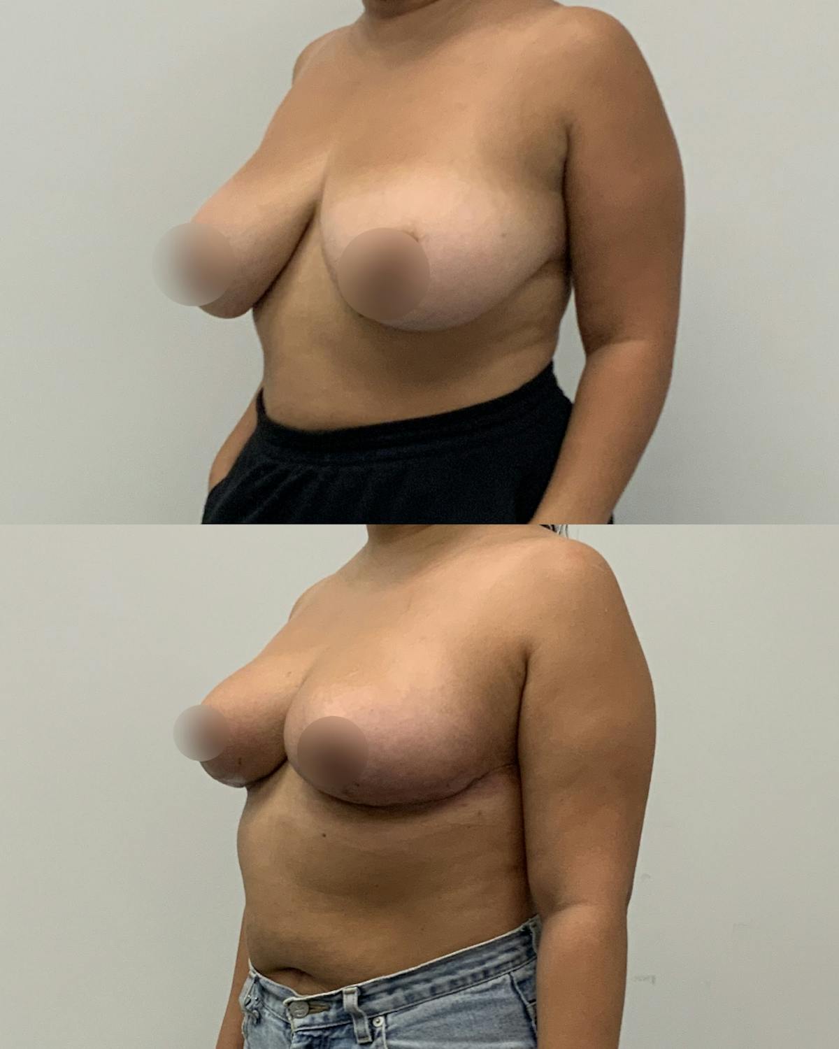 Breast Reduction Before & After Gallery - Patient 203182 - Image 2