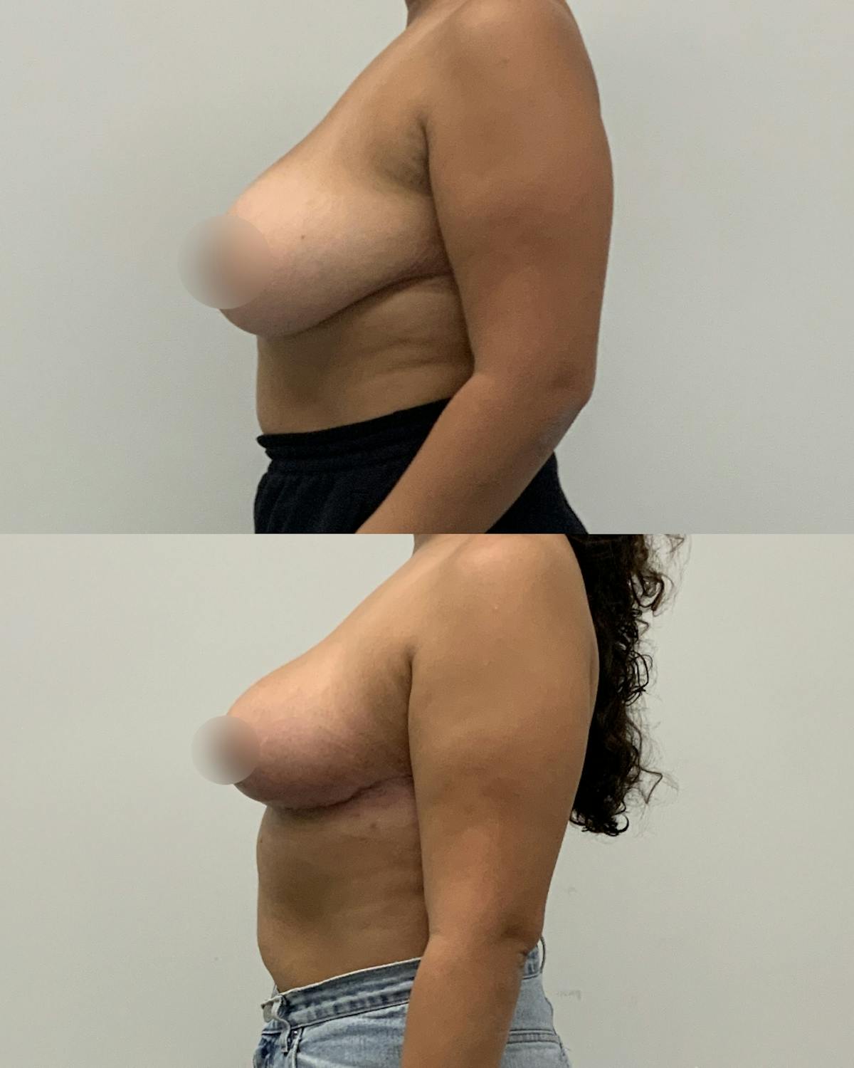 Breast Reduction Before & After Gallery - Patient 203182 - Image 3