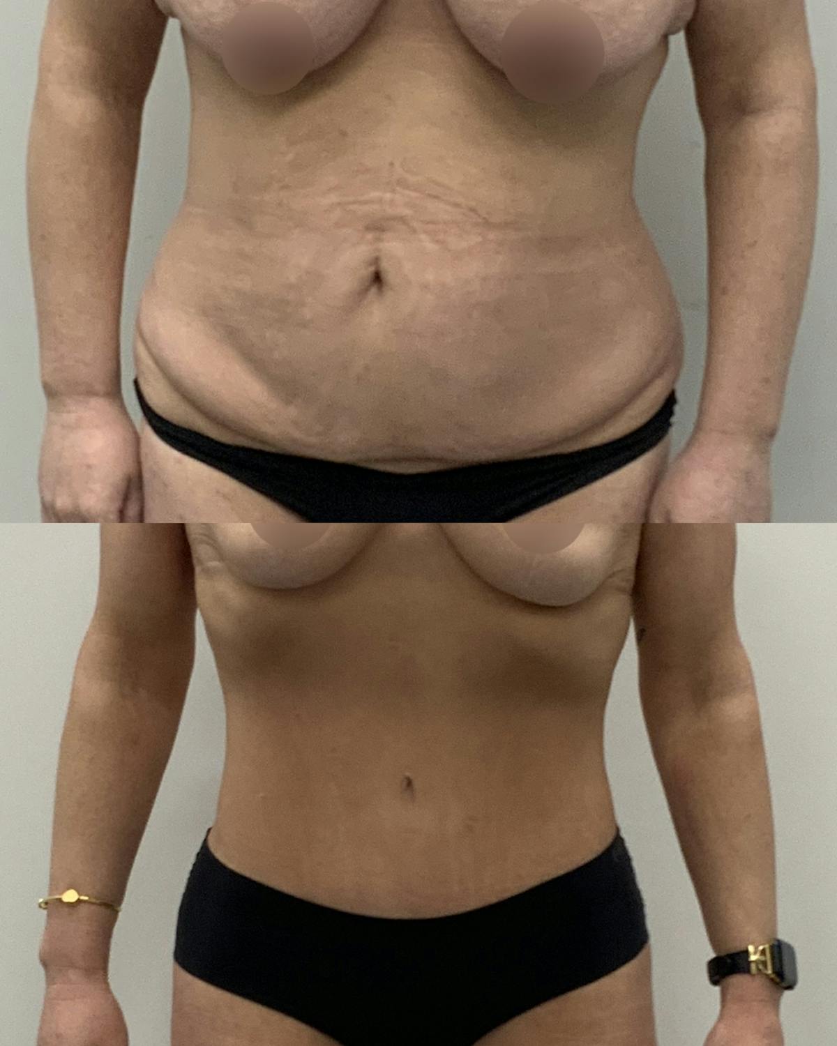 Tummy Tuck Before & After Gallery - Patient 217834 - Image 1