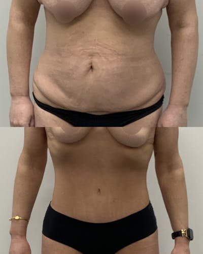 Tummy Tuck Before & After Gallery - Patient 217834 - Image 1
