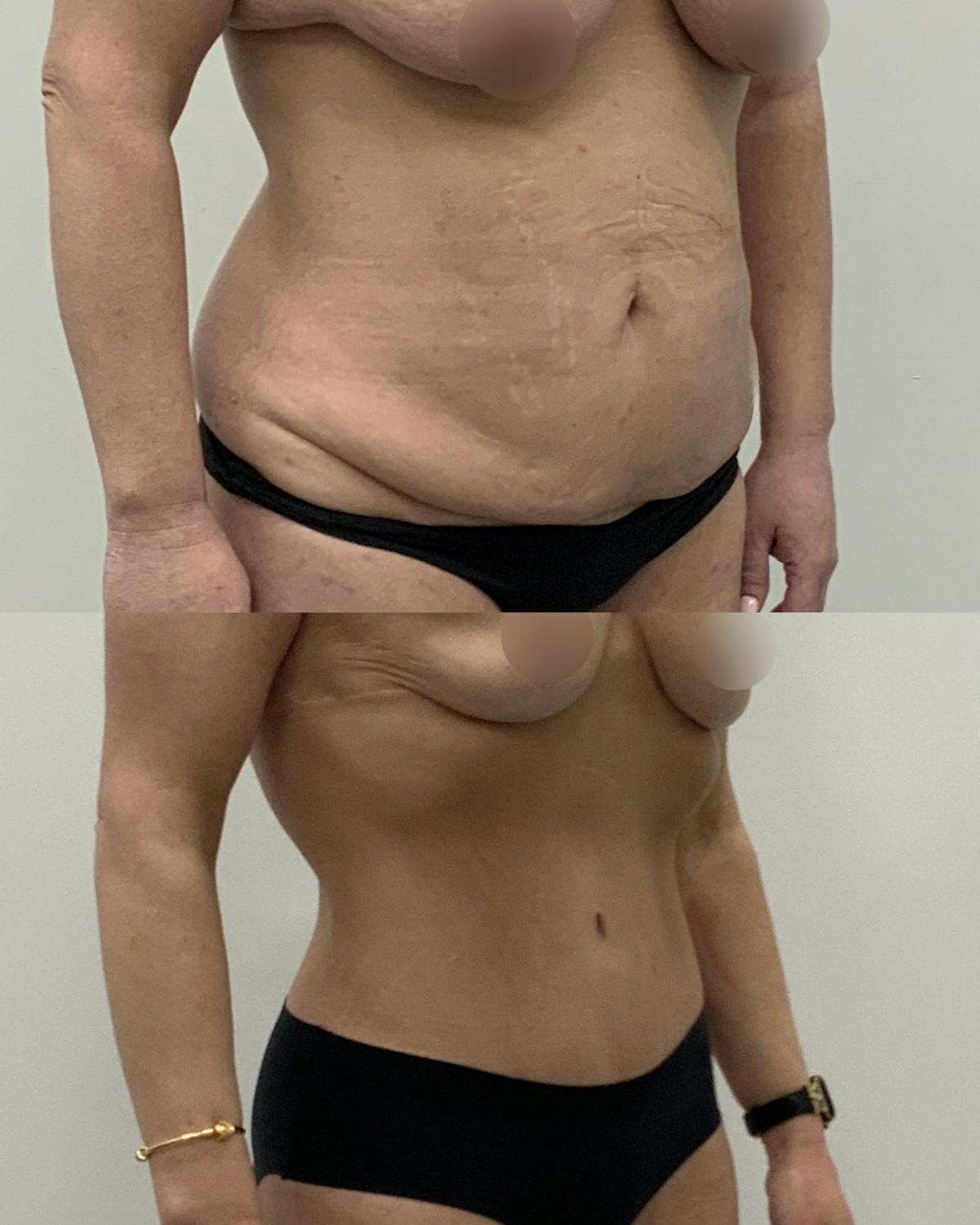 Tummy Tuck Before & After Gallery - Patient 217834 - Image 2