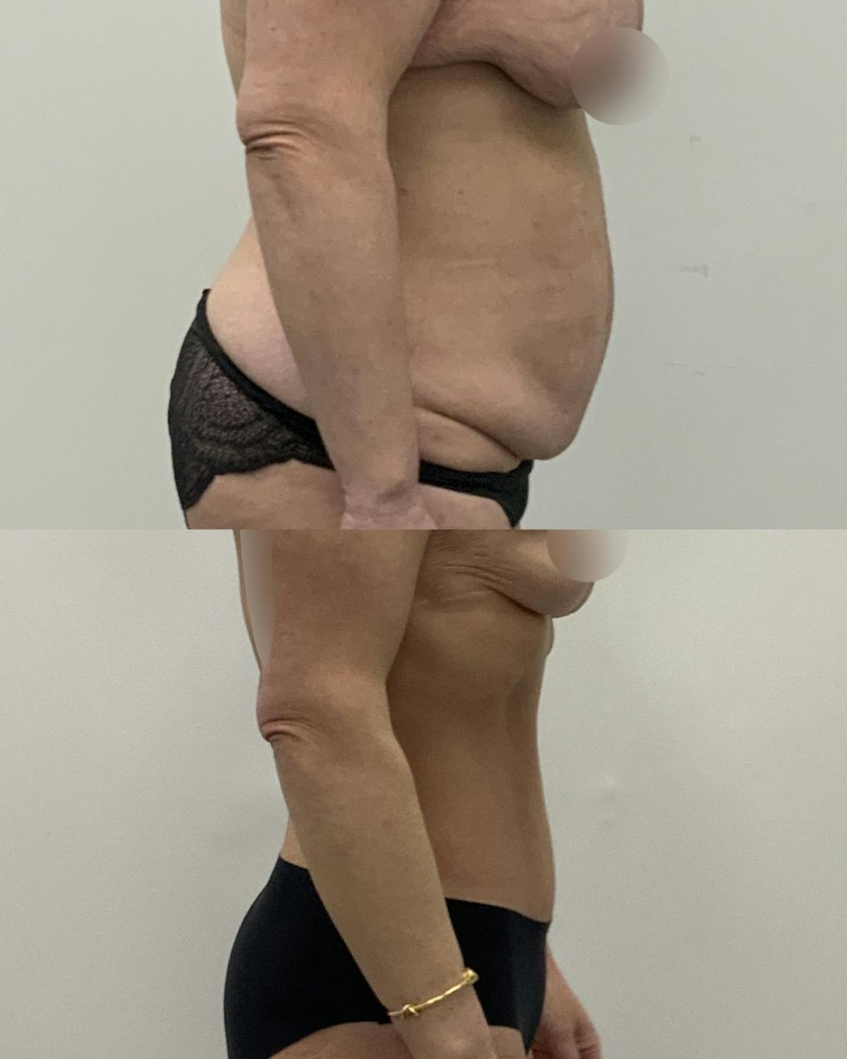 Tummy Tuck Before & After Gallery - Patient 217834 - Image 3