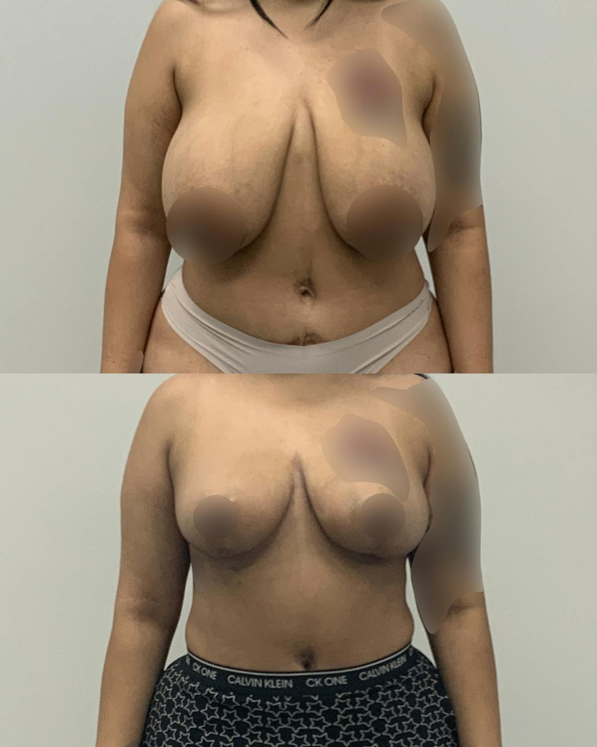 Breast Lift Before & After Gallery - Patient 273939 - Image 1