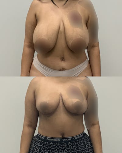 Breast Lift Before & After Gallery - Patient 273939 - Image 1