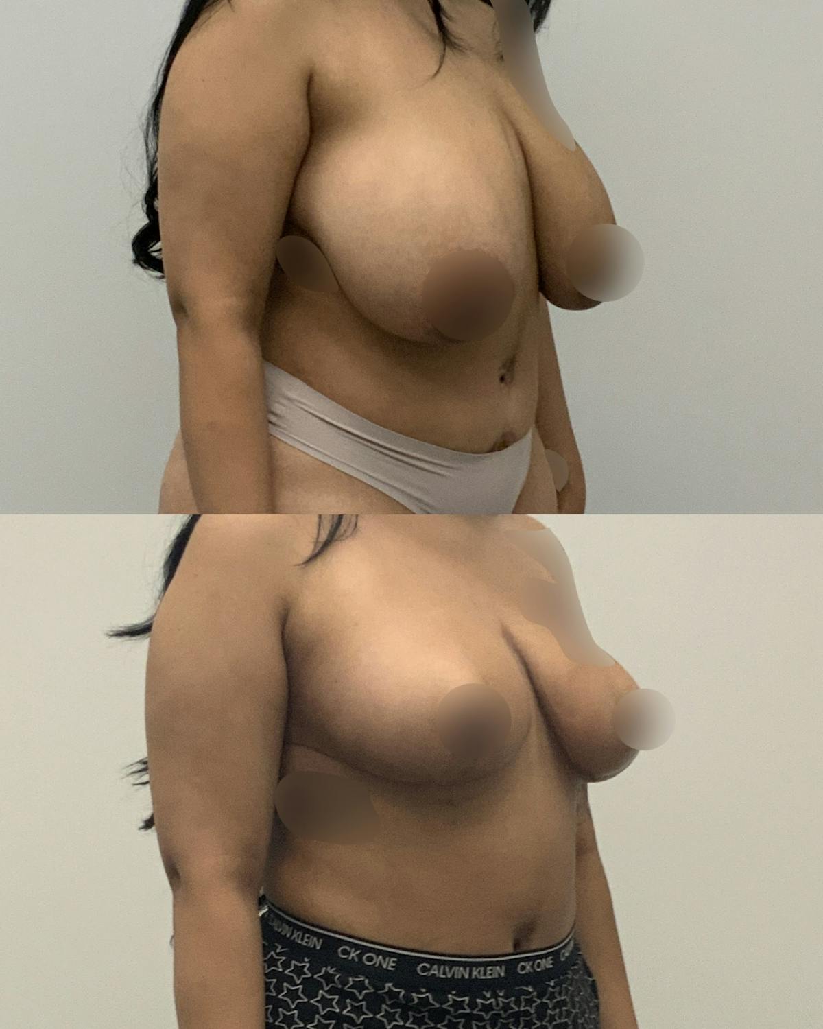 Breast Lift Before & After Gallery - Patient 273939 - Image 2
