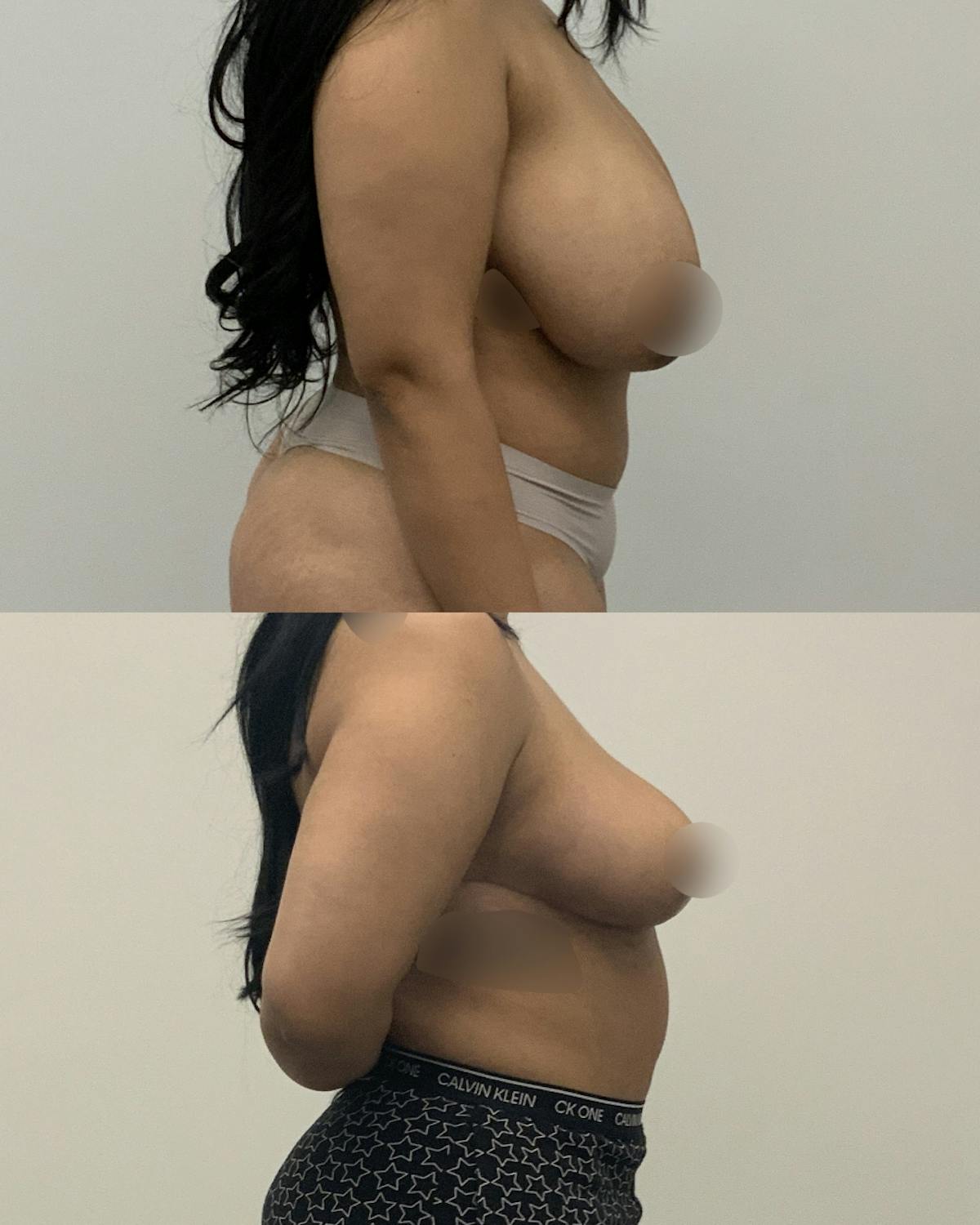 Breast Lift Before & After Gallery - Patient 273939 - Image 3