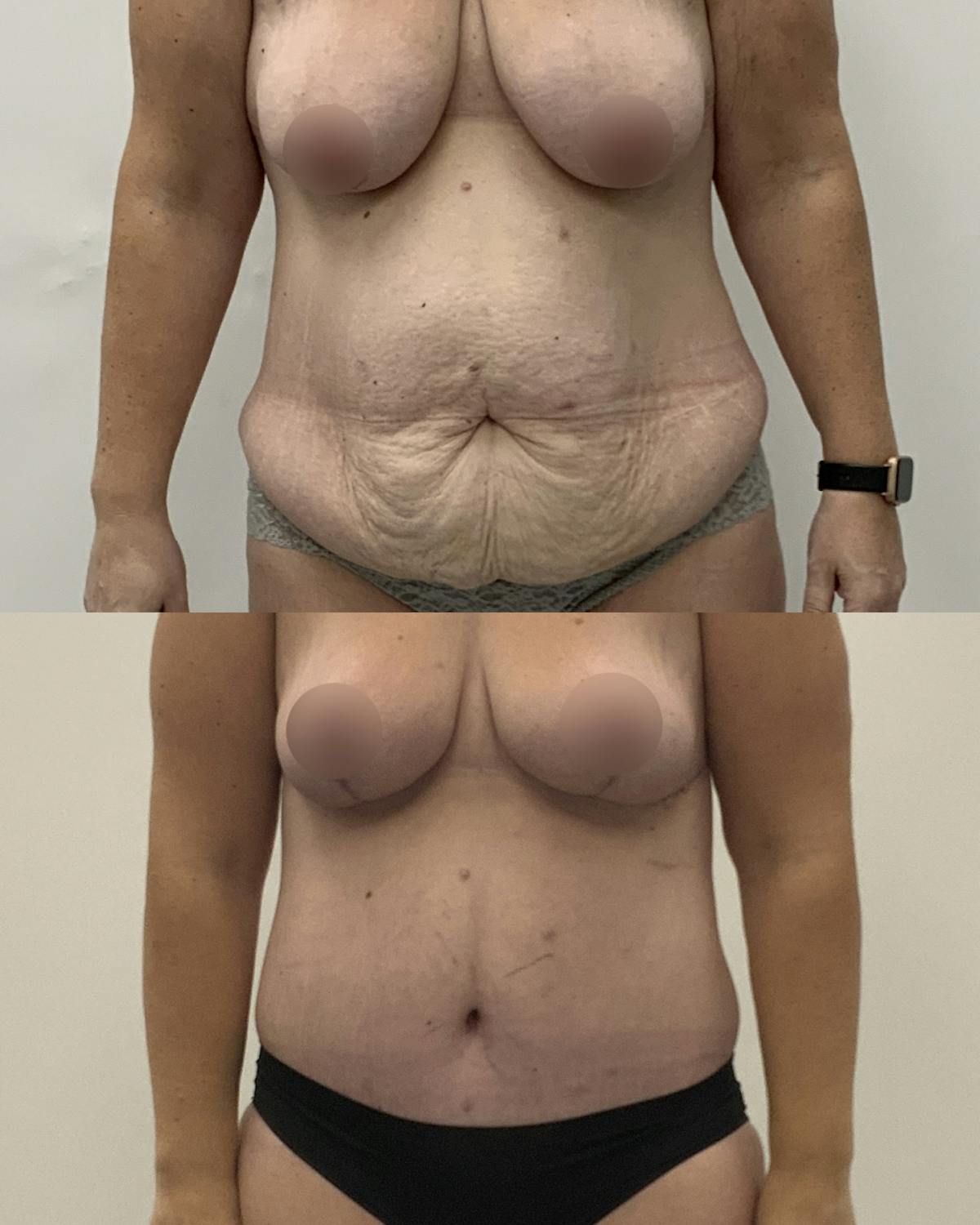 Tummy Tuck Before & After Gallery - Patient 183315 - Image 1