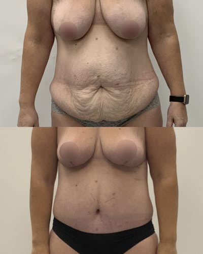 Tummy Tuck Before & After Gallery - Patient 183315 - Image 1