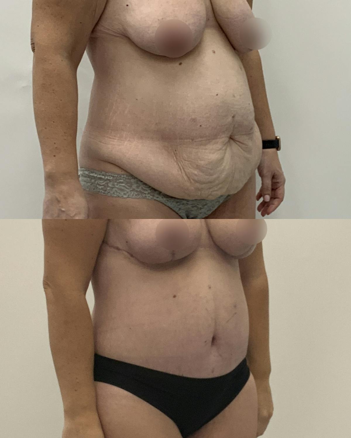 Tummy Tuck Before & After Gallery - Patient 183315 - Image 2