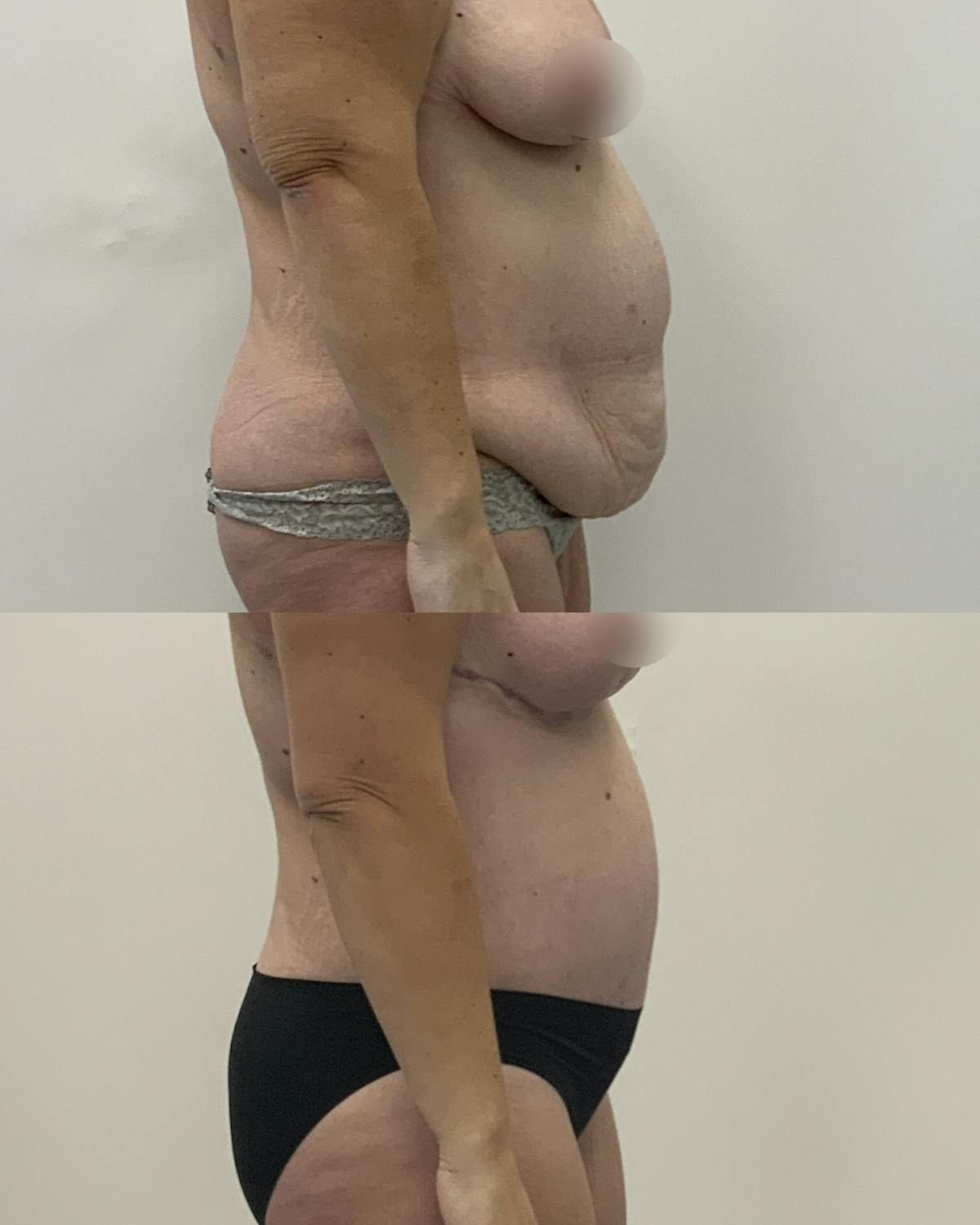 Tummy Tuck Before & After Gallery - Patient 183315 - Image 3