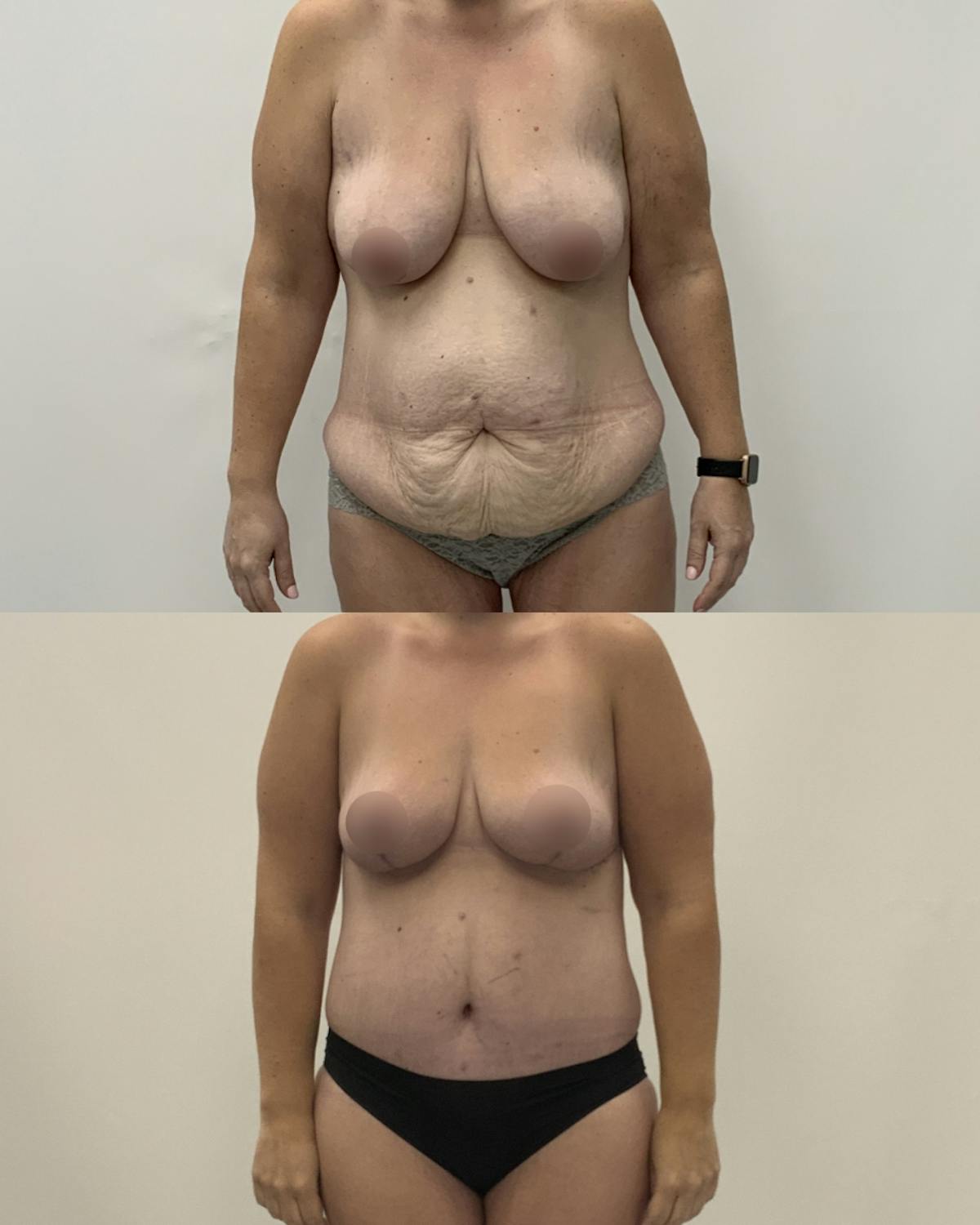 Mommy Makeover Before & After Gallery - Patient 107022 - Image 1