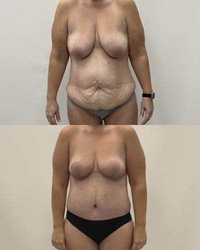 Mommy Makeover Before & After Gallery - Patient 107022 - Image 1