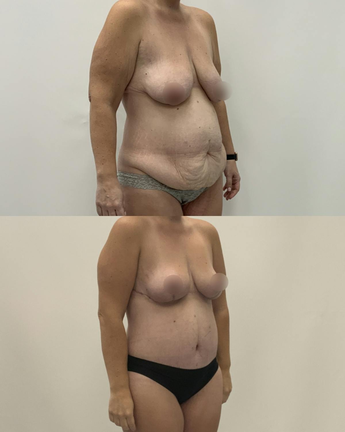 Mommy Makeover Before & After Gallery - Patient 107022 - Image 2