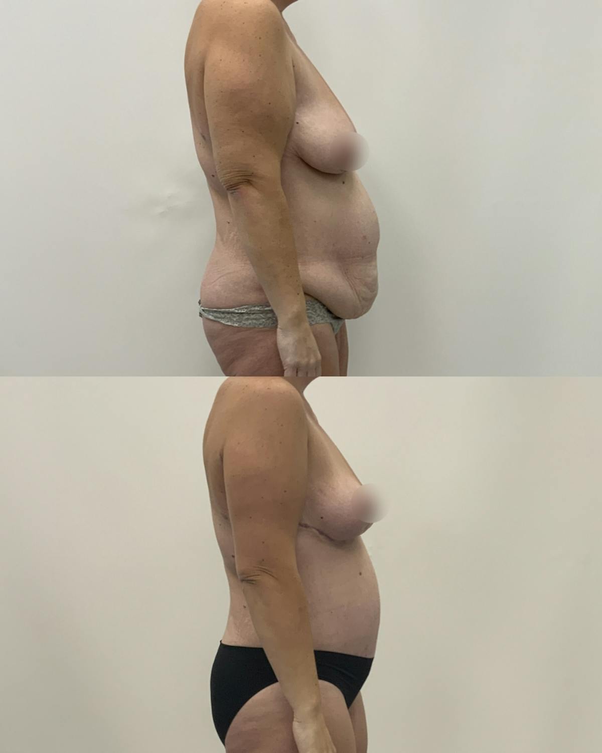 Mommy Makeover Before & After Gallery - Patient 107022 - Image 3