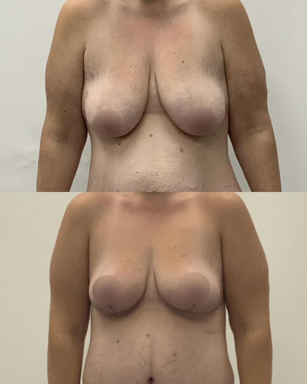 Breast Reduction Before & After Gallery - Patient 387042 - Image 1