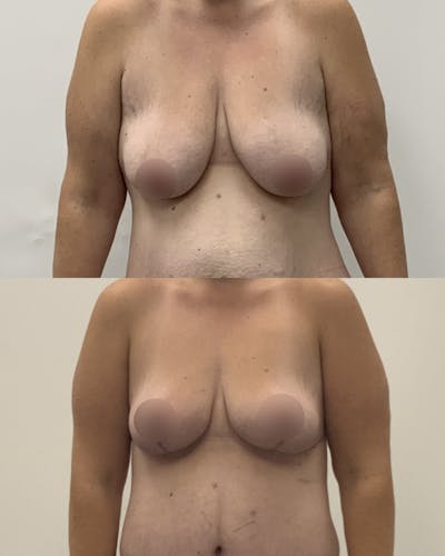 Breast Lift Before & After Gallery - Patient 297156 - Image 1