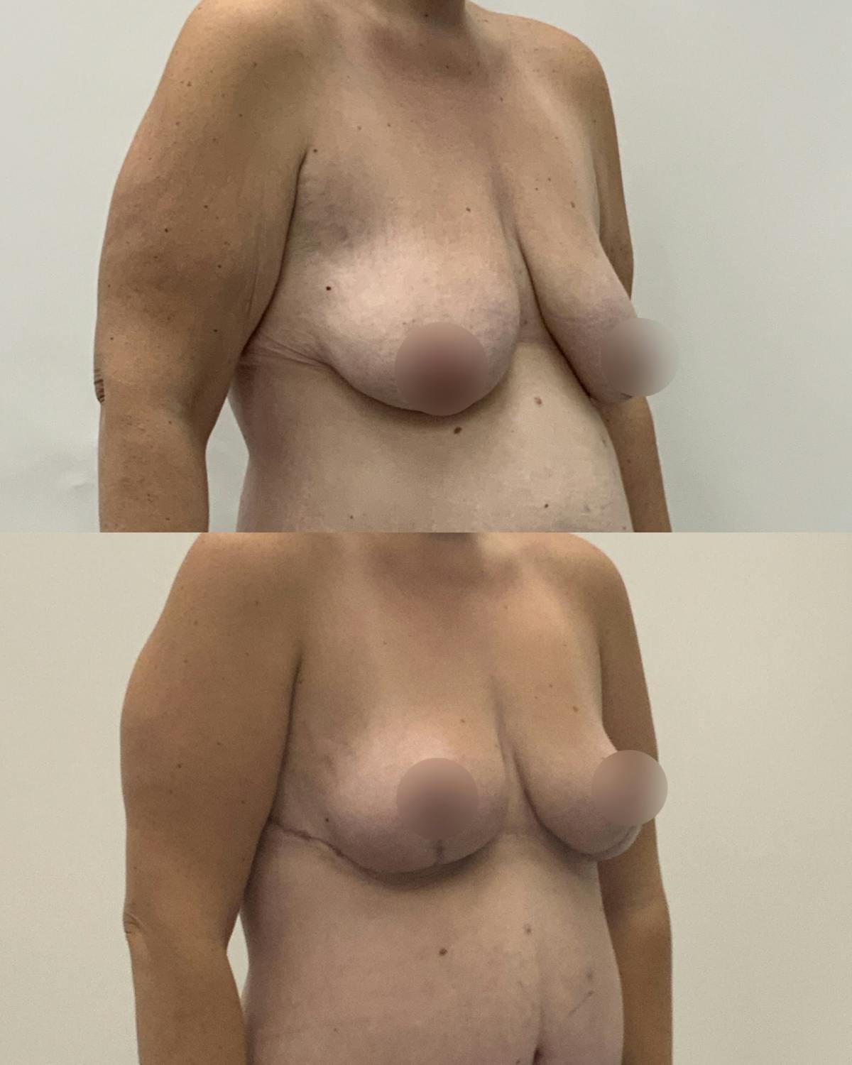 Breast Reduction Before & After Gallery - Patient 387042 - Image 2