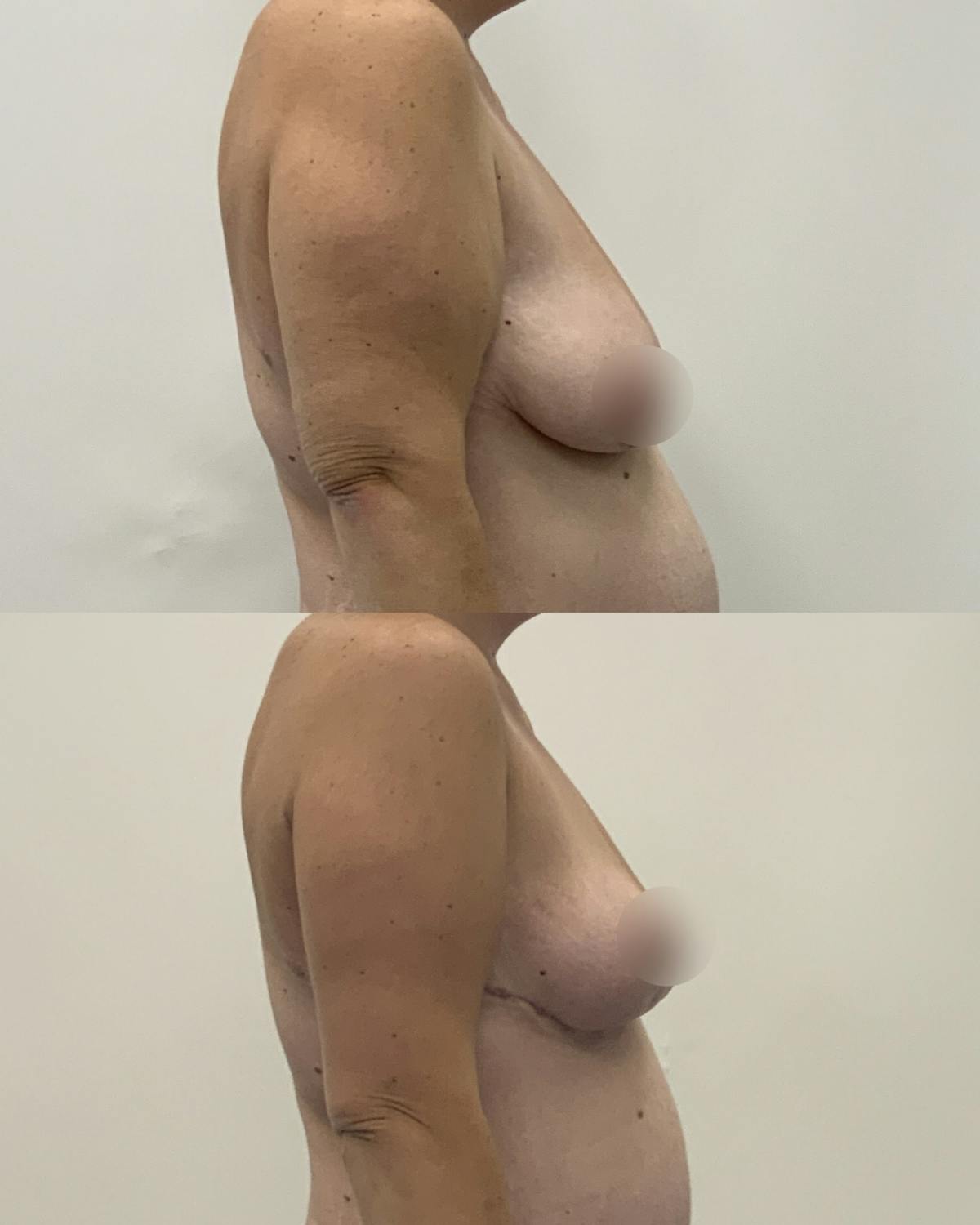 Breast Reduction Before & After Gallery - Patient 387042 - Image 3