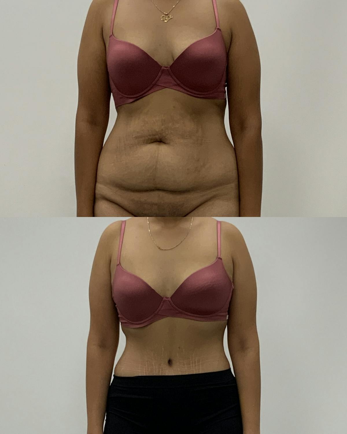 Tummy Tuck Before & After Gallery - Patient 428910 - Image 1
