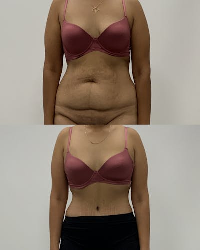 Tummy Tuck Before & After Gallery - Patient 428910 - Image 1
