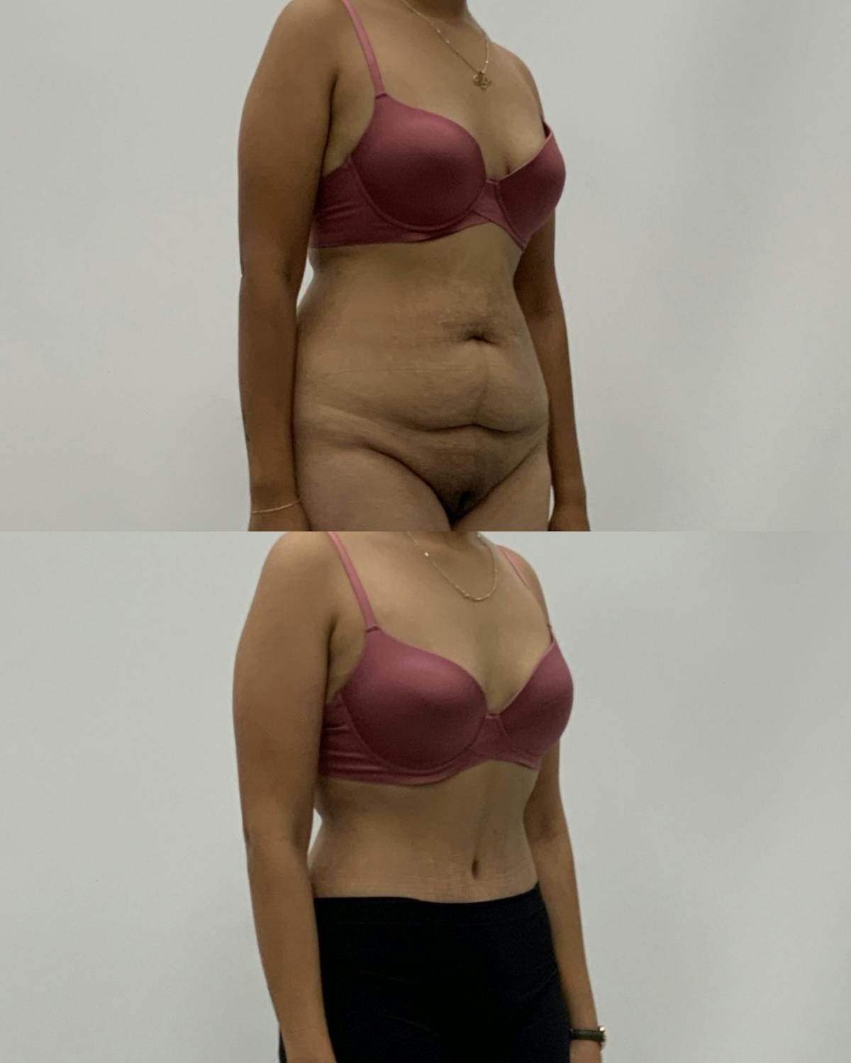 Tummy Tuck Before & After Gallery - Patient 428910 - Image 2