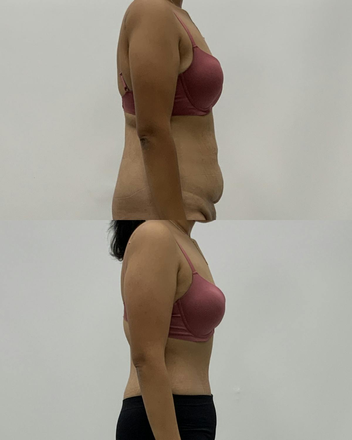Tummy Tuck Before & After Gallery - Patient 428910 - Image 3