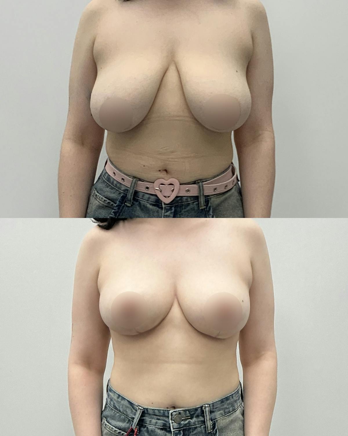 Breast Reduction Before & After Gallery - Patient 629678 - Image 1