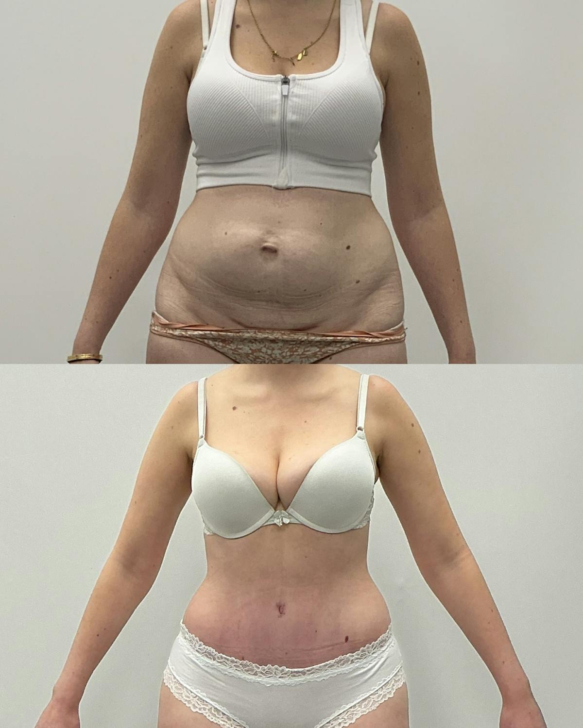 Tummy Tuck Before & After Gallery - Patient 305297 - Image 1