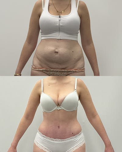 Tummy Tuck Before & After Gallery - Patient 305297 - Image 1
