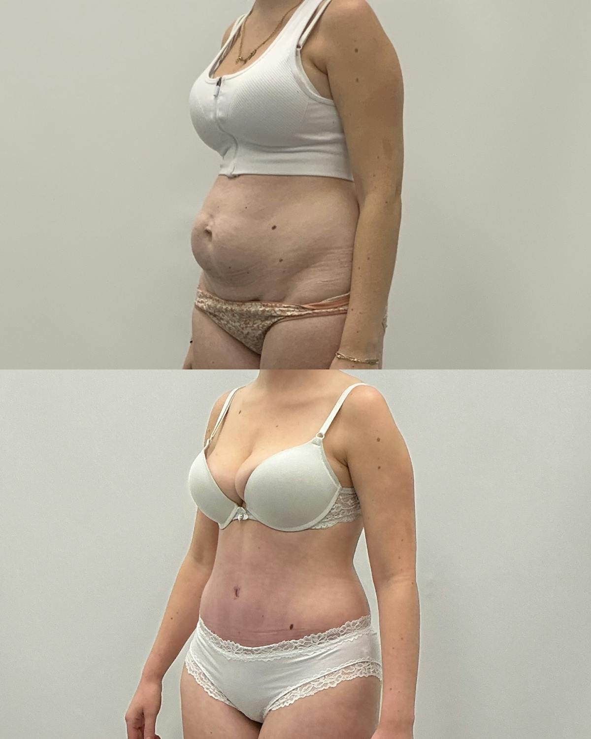 Tummy Tuck Before & After Gallery - Patient 305297 - Image 2