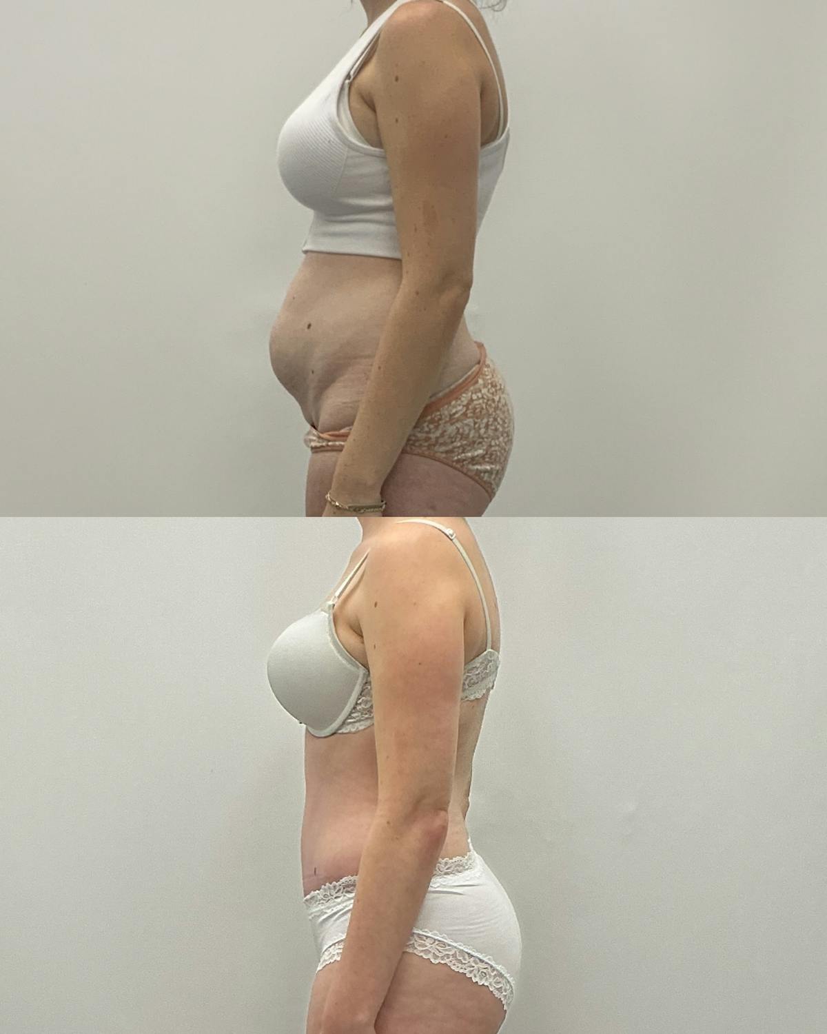 Tummy Tuck Before & After Gallery - Patient 305297 - Image 3