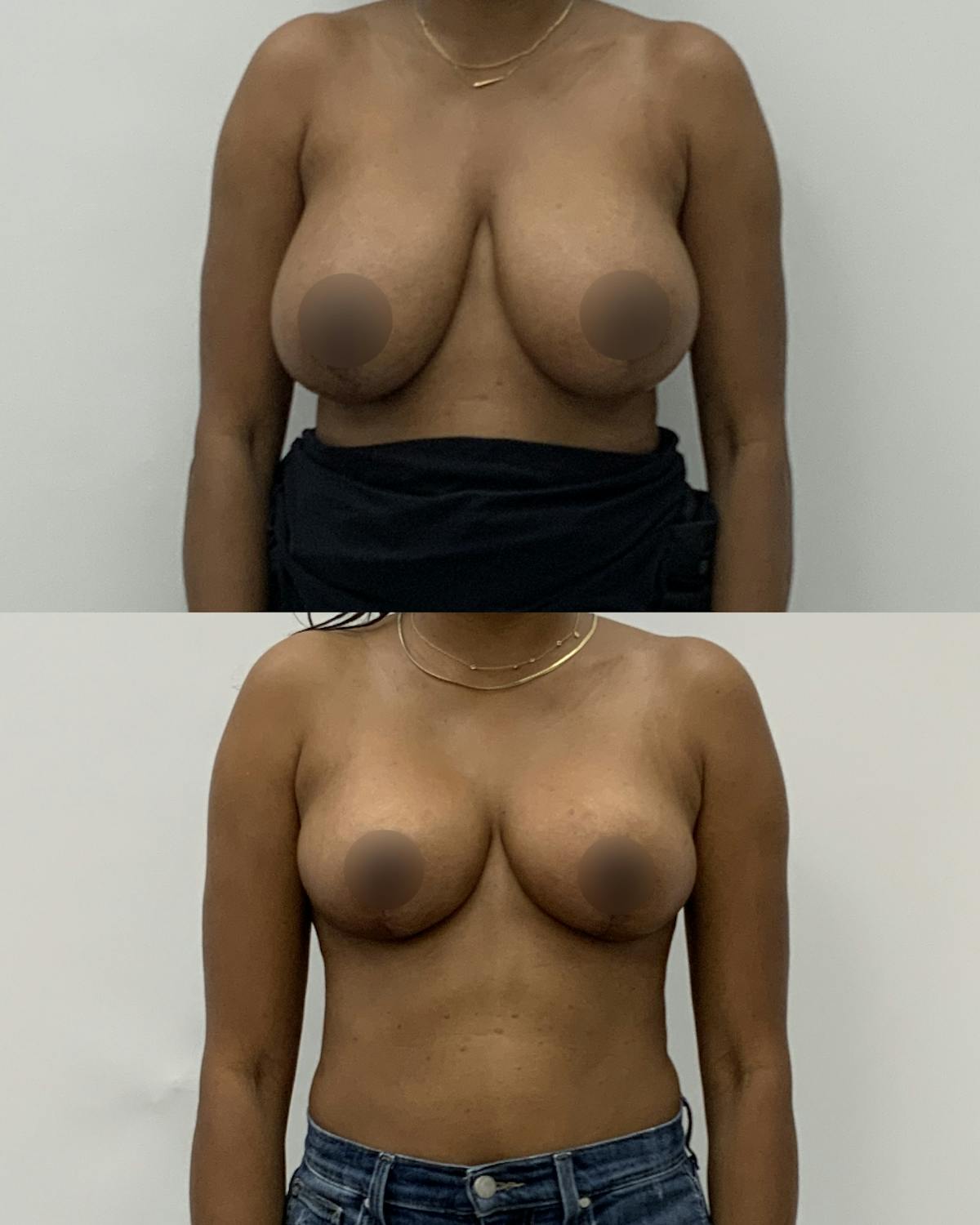 Breast Reduction Before & After Gallery - Patient 410093 - Image 1