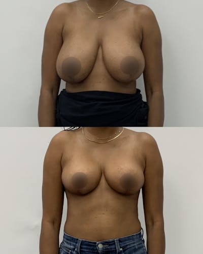 Breast Lift Before & After Gallery - Patient 137563 - Image 1