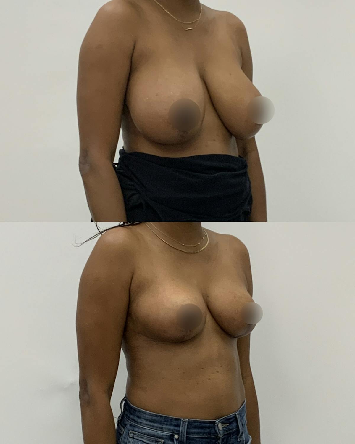 Breast Reduction Before & After Gallery - Patient 410093 - Image 2