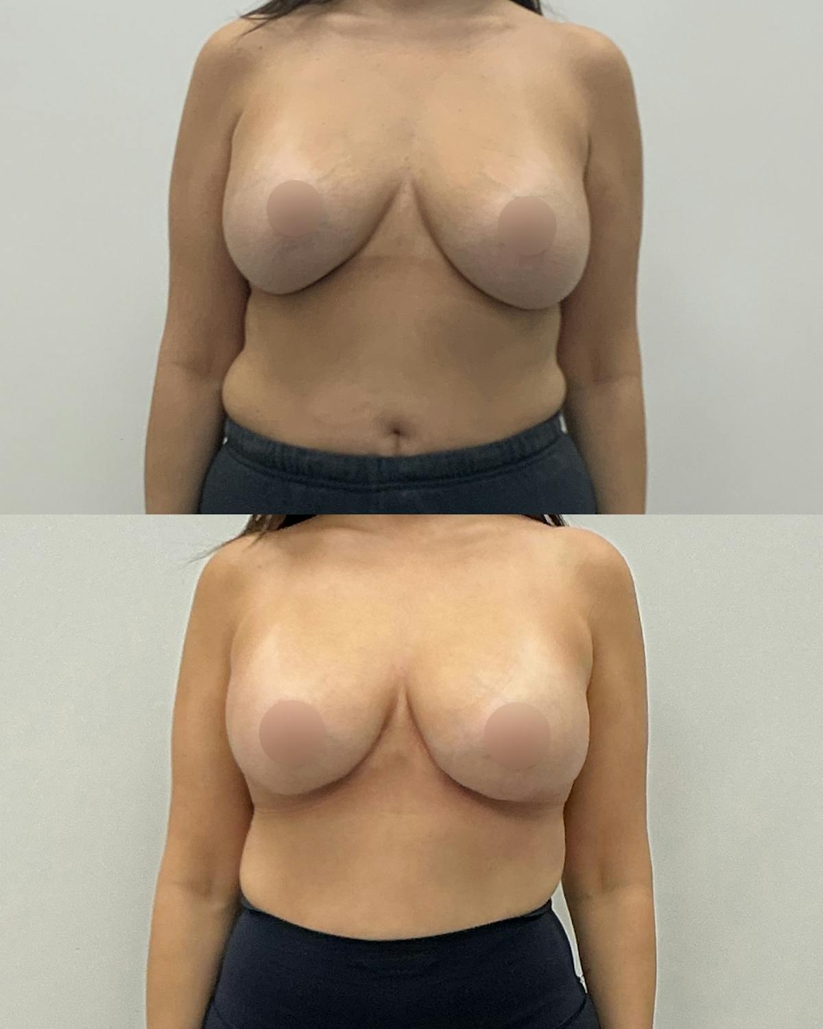 Breast Lift Before & After Gallery - Patient 361231 - Image 1