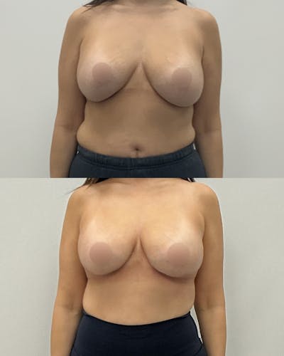Breast Lift Before & After Gallery - Patient 361231 - Image 1