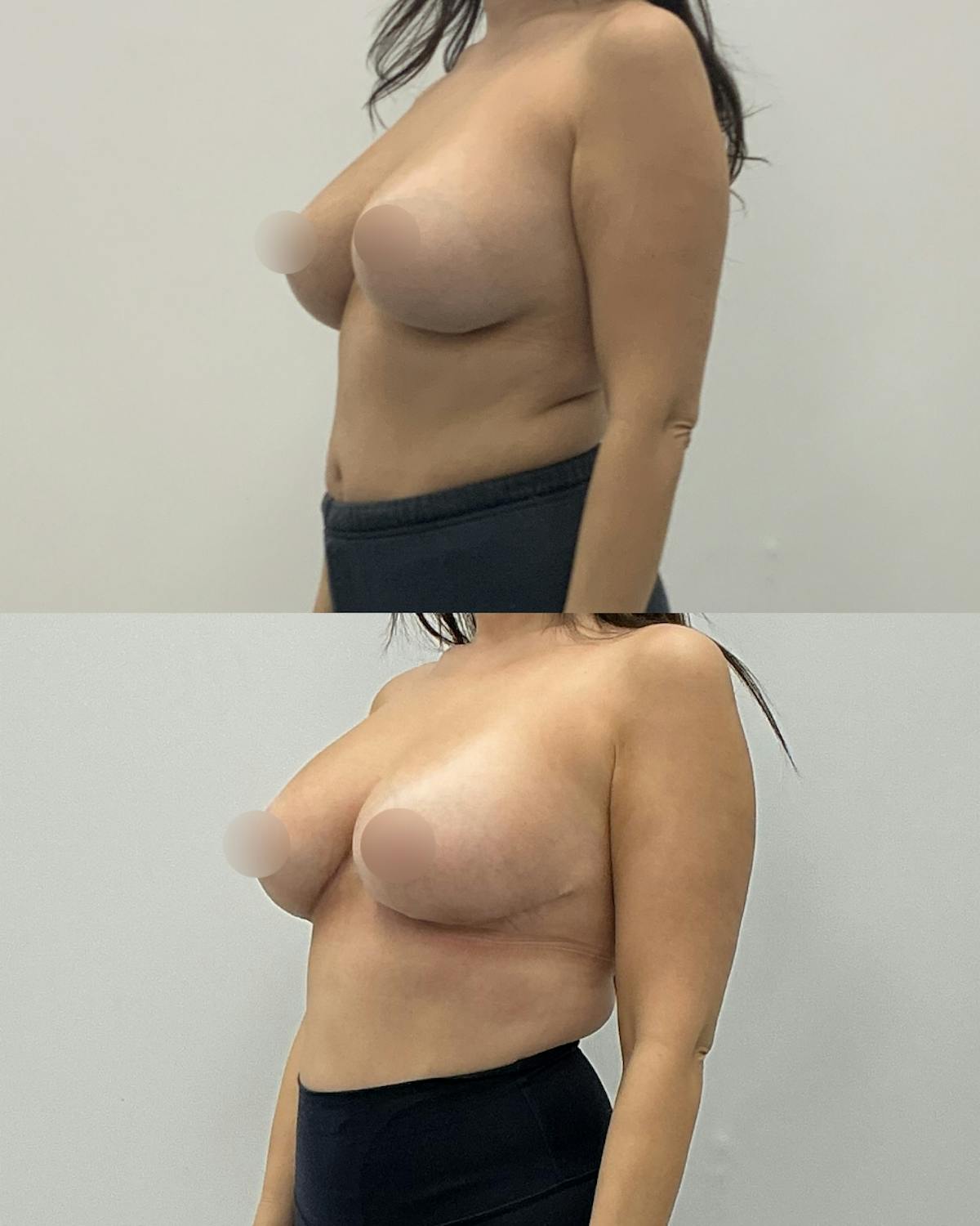 Breast Lift Before & After Gallery - Patient 361231 - Image 2