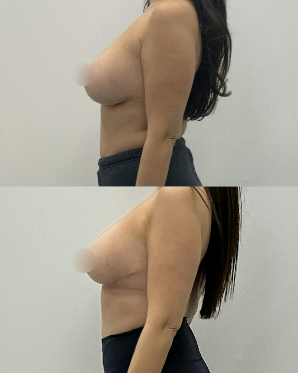 Breast Lift Before & After Gallery - Patient 361231 - Image 3
