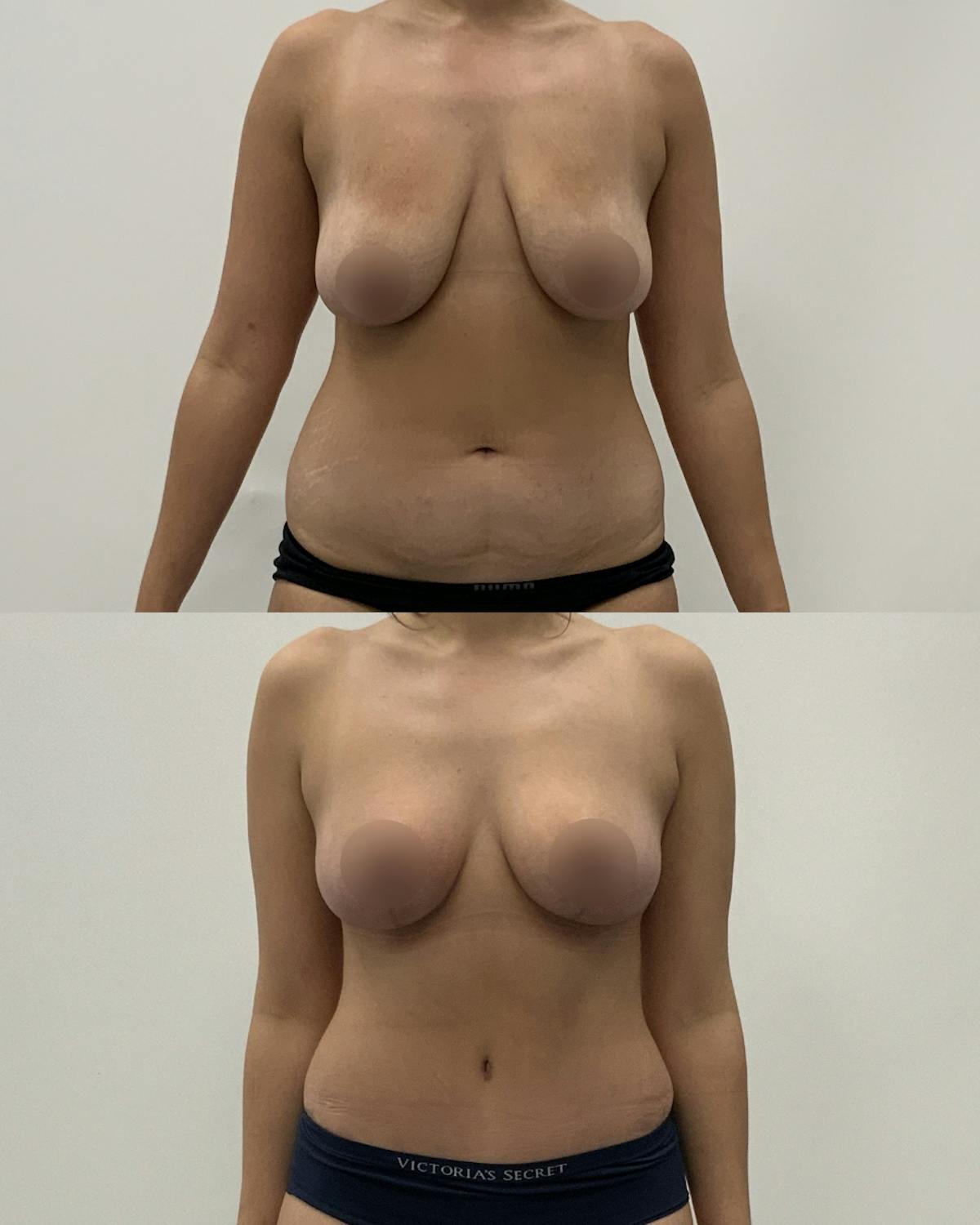 Mommy Makeover Before & After Gallery - Patient 919986 - Image 1
