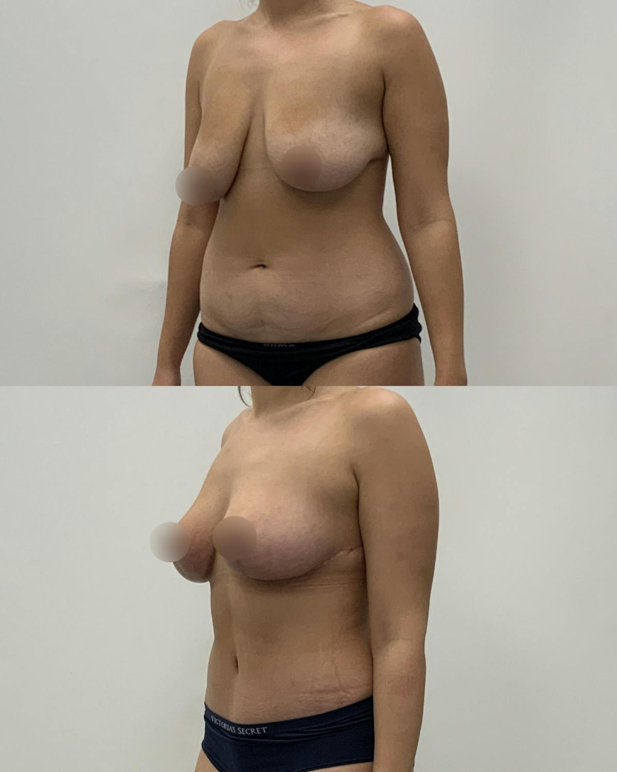 Mommy Makeover Before & After Gallery - Patient 919986 - Image 2