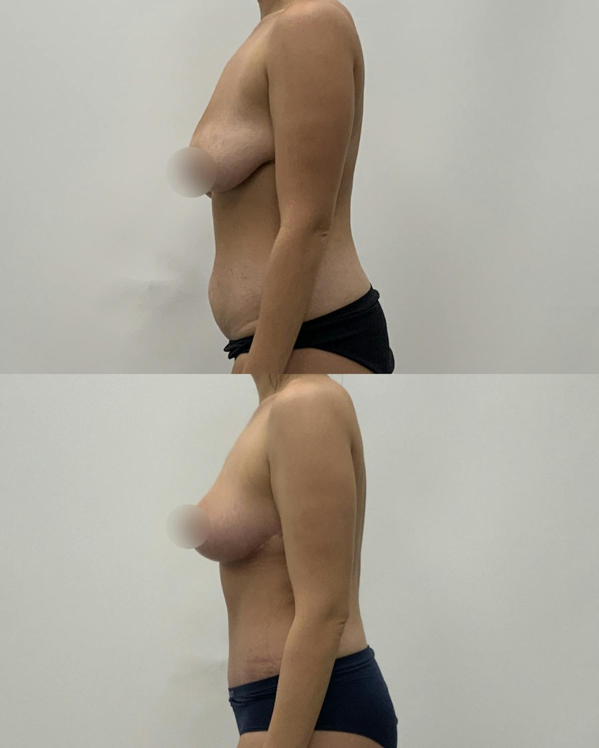 Mommy Makeover Before & After Gallery - Patient 919986 - Image 3