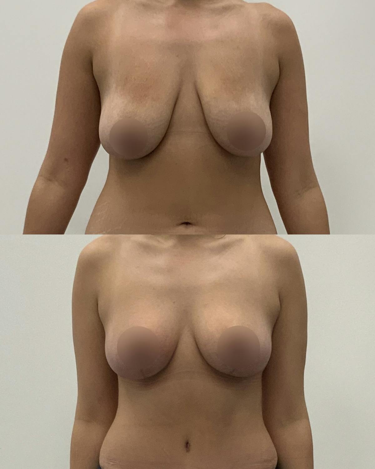 Breast Lift Before & After Gallery - Patient 700136 - Image 1