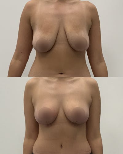 Breast Lift Before & After Gallery - Patient 700136 - Image 1