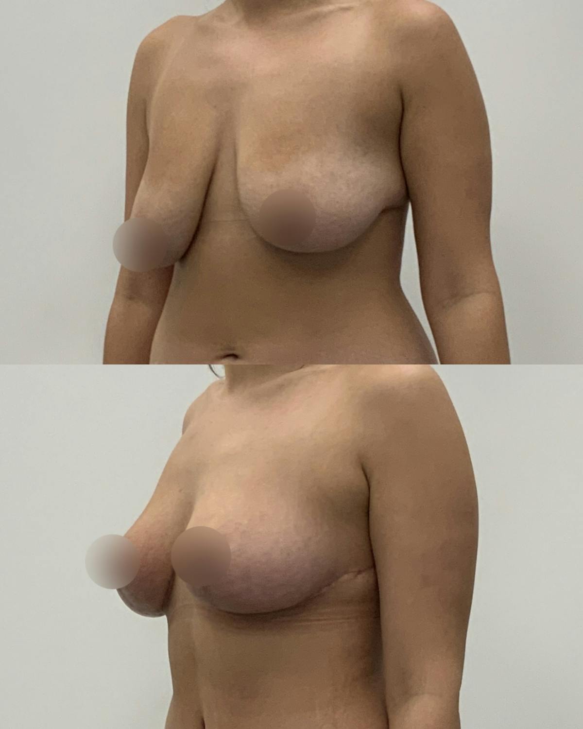 Breast Lift Before & After Gallery - Patient 700136 - Image 2