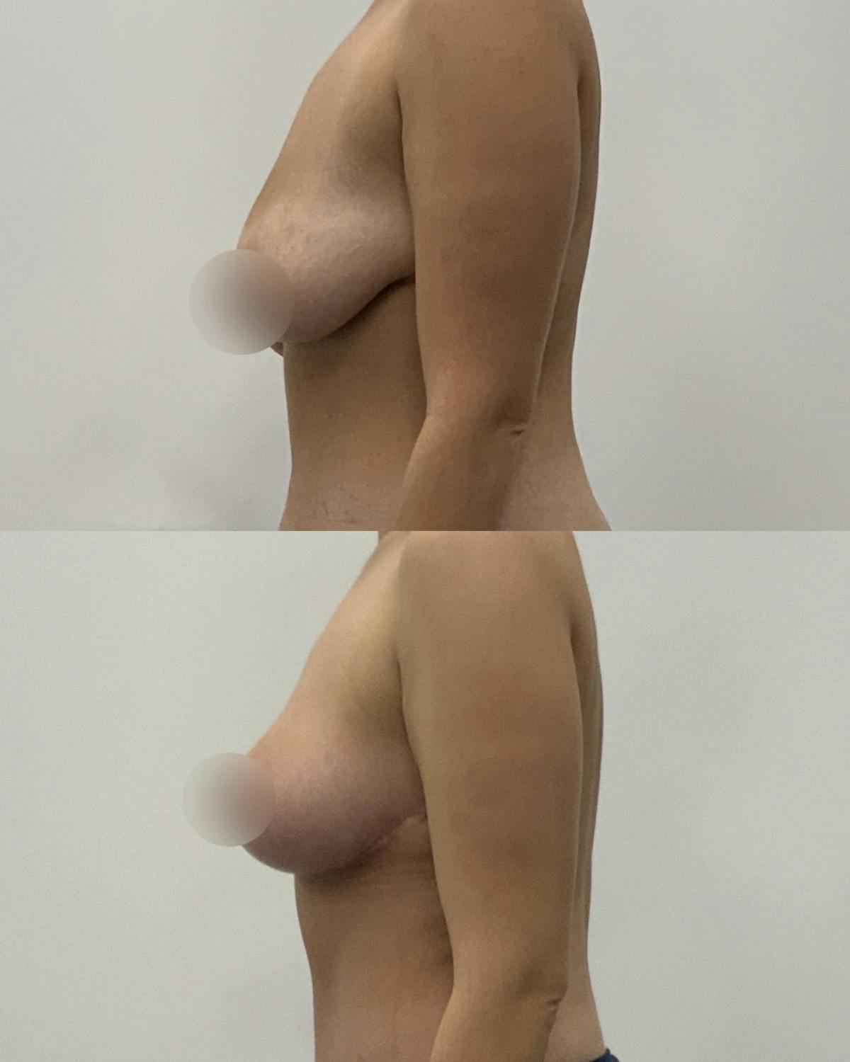 Breast Lift Before & After Gallery - Patient 700136 - Image 3